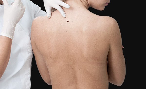 skin cancer - model image 001