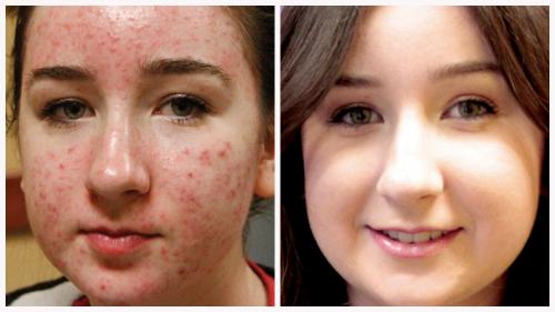 Case 1 - acne