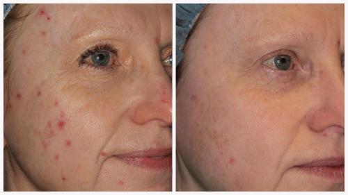 Case 2 - acne