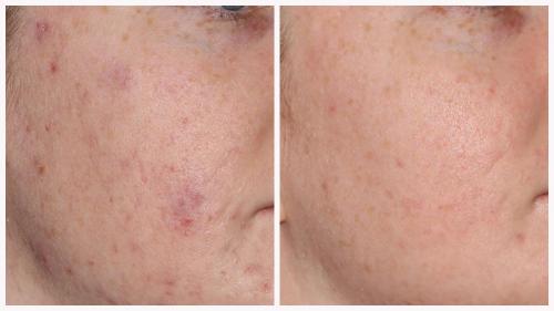 Case 3 - acne