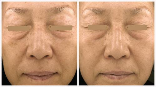 Case 3 - Skin Tightening