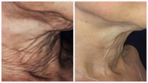Case 2 - Skin Tightening