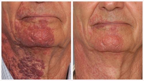 Case 2 - Vascular Lesions