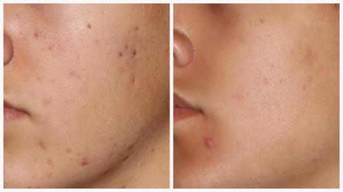 Case 4 - acne