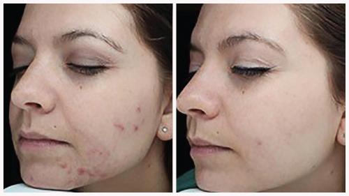 Case 6 - acne